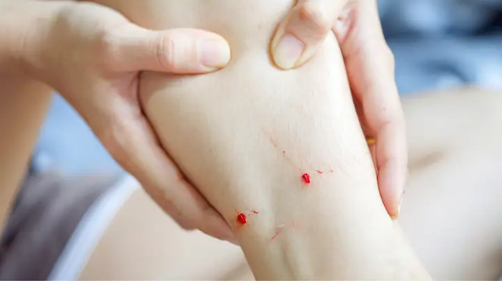 Bà Bầu Bị Chó Cắn Có Cần Điều Trị Ngay Không?