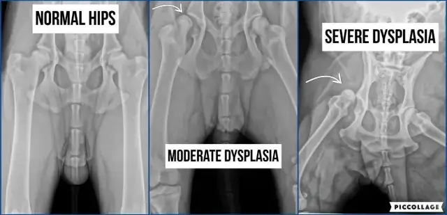 Loạn Sản Xương Hông