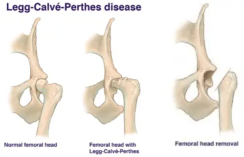 Hoại Tử Vô Khuẩn Chỏm Xương Đùi Ở Chó