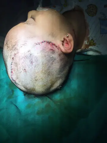 Bé 2 Tuổi Bị Chó Cắn Với Các Vết Thương Nặng - Ảnh 1.