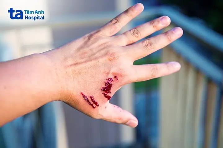 Bị Chó Cắn Vào Cổ: Hướng Dẫn Xử Lý An Toàn Và Kịp Thời