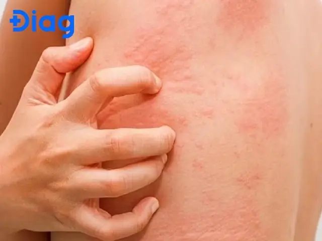 Bị Sán Chó Có Ngứa Không?