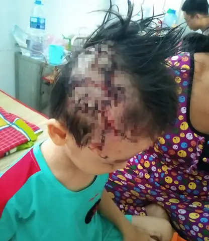 Bã© Trai 5 Tuá»i Bá» Chã³ Bã©cgi㪠17kg Cắn Tã©t Da Äầu, Rã¡ch Mã Mắt Bã© Trai 5 Tuá»i Bá» Chã³ Bã©cgi㪠17kg Cắn Tã©t Da Äầu, Rã¡ch Mã Mắt