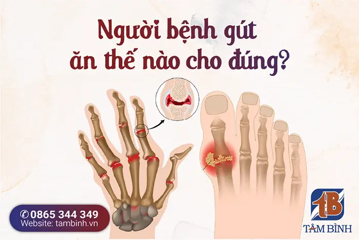 Bệnh Gout Ăn Sao Cho Đúng – Lời Khuyên Từ Chuyên Gia