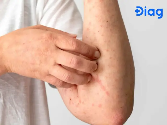 Tác Hại Khi Uống Thuốc Tẩy Giun Quá Liều