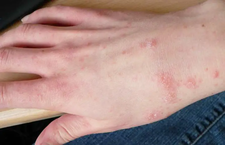 Cách Trị Ghẻ Bằng Lá Trầu Không Có Hiệu Quả Không?