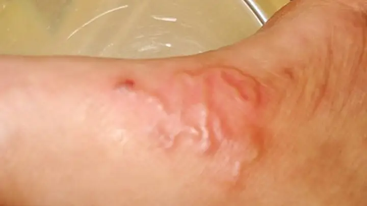 Giảm Cân Đột Ngột