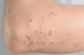 Xét Nghiệm Giun Đũa Chó