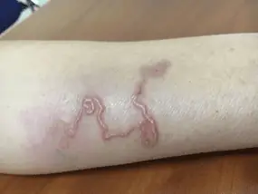 Xét Nghiệm Giun Đũa Chó