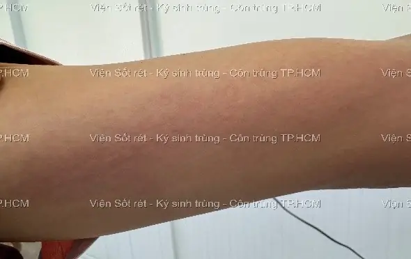 Bệnh Giun Đũa Chó Mèo