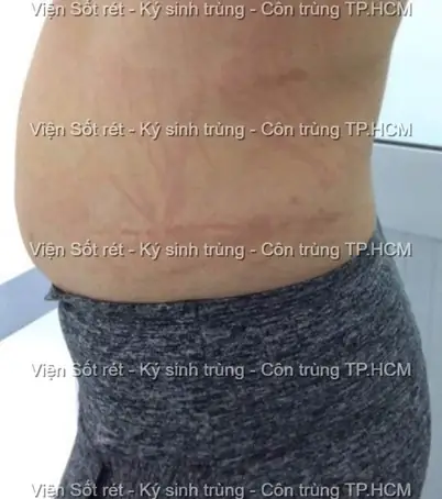 Bệnh Giun Đũa Chó Mèo