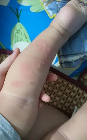 Nếu Thấy Con Bỗng Dưng Sụt Cân Đột Ngột, Trằn Trọc Khó Ngủ Về Đêm Và Đặc Biệt Là Thường Xuyên Ngứa, Các Mẹ Nên Đưa Con Đi Khám Vì Có Thể Bé Đã Bị Nhiễm Ký Sinh Trùng.