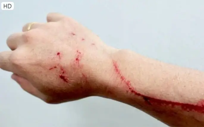 Hướng Dẫn Nhận Diện Và Xử Lý Vết Thương Do Chó Cắn: Hình Ảnh & Kiến Thức Cần Biết