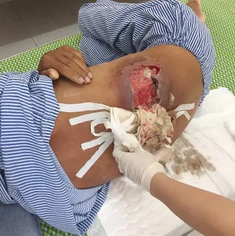 Hướng Dẫn Nhận Diện Và Xử Lý Vết Thương Do Chó Cắn: Hình Ảnh & Kiến Thức Cần Biết