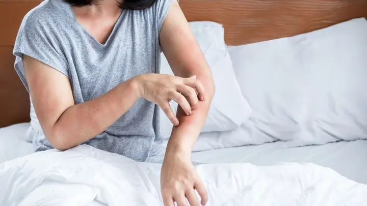Dị Ứng Da Kéo Dài Không Rõ Nguyên Nhân