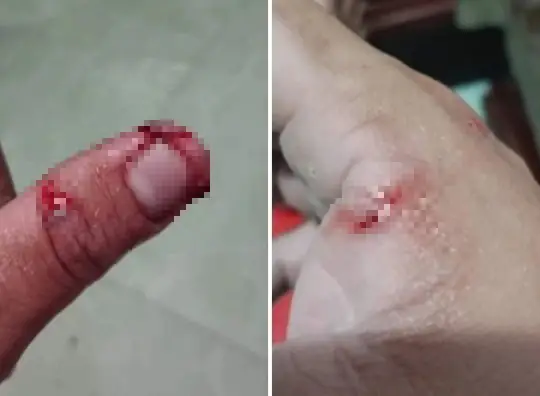 Người Bị Chó Dại Cắn Lên Cơn: Dấu Hiệu, Tiến Triển Và Cách Xử Lý Kịp Thời