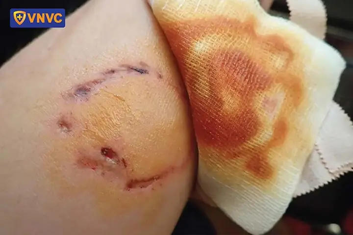 Xử Trí Và Theo Dõi Sau Khi Bị Chó Nhà Cắn