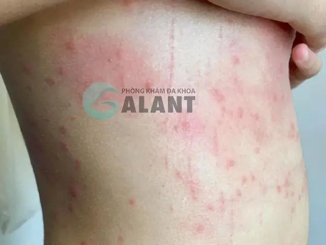 Sán Chó Thường Truyền Sang Người Như Thế Nào? Sán Chó Thường Truyền Sang Người Như Thế Nào?