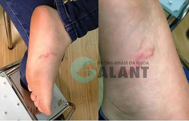 Sán Chó Có Lây Từ Người Sang Người Không?