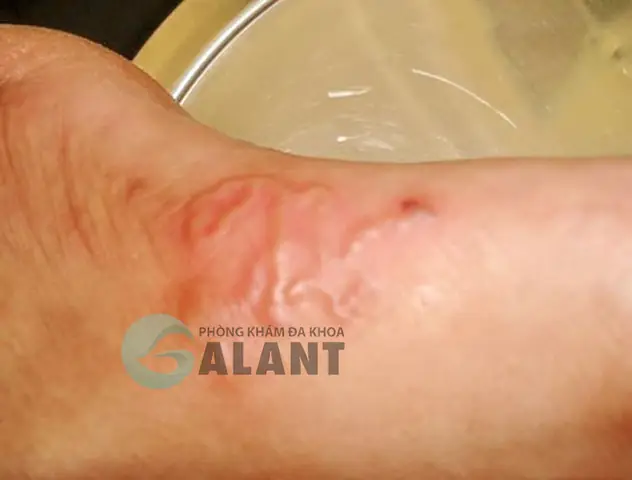 Thời Gian Ủ Bệnh Sán Chó Ở Người Bao Lâu? Thời Gian Ủ Bệnh Sán Chó Ở Người Bao Lâu?