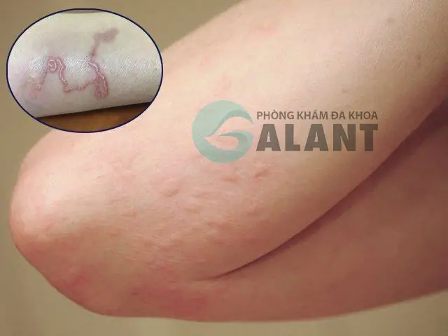 Tiêm Ngừa Giun Sán Cho Chó