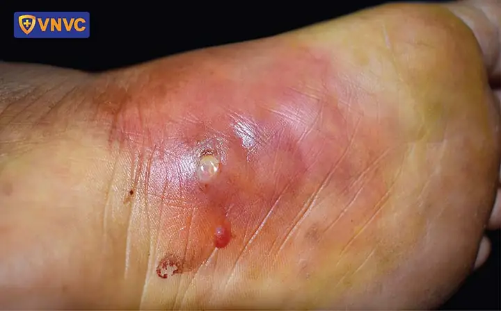 Vắc Xin Uốn Ván