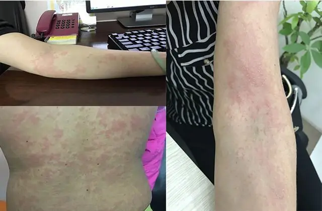 Triệu Chứng Nhiễm Sán Chó Ở Người Lớn