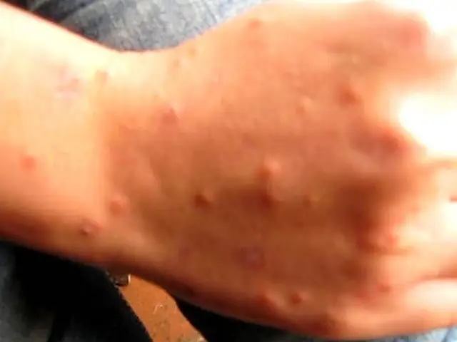 Bọ Chét Chó Có Cắn Người Không