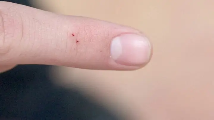 Cách Nhận Biết Rắn Có Độc Và Rắn Không Có Độc Qua Vết Răng Rắn Cắn