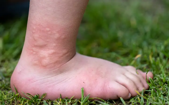 Triệu Chứng Khi Bị Chuột Cắn Triệu Chứng Khi Bị Chuột Cắn