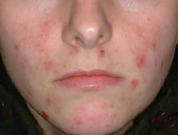 Ghẻ Demodex Ở Chó Có Lây Sang Người Không?