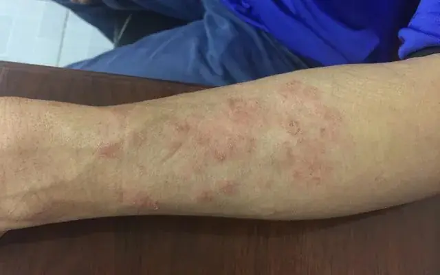 Nguyên Nhân Gây Nhiễm Giun Đũa Chó Mèo