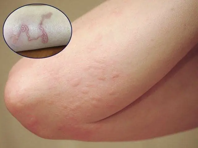 Khi Vật Chủ Hoặc Cơ Thể Người Tiếp Xúc Với Ký Sinh Trùngtoxocara.chúng Nhanh Chóng Xâm Nhập Vào Cơ Thể Người Và Gây Viêm Bàng Quang. Điều Đáng Chú Ý Là Trong Cơ Thể Con Người, Loại Ký Sinh Trùng Này Không Biến Đổi Ngay Thành Một Con Sán Dây Nhỏ. Mà Tồn Tại Dưới Dạng Ấu Trùng Di Chuyển Qua Đường Máu Và Thành Ruột Để Đến Nhiều Nơi Trong Cơ Thể Con Người.