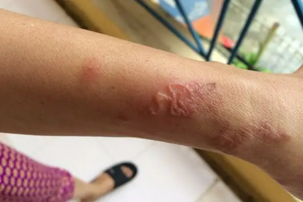 Dấu Hiệu Nhận Biết Nhiễm Giun Đũa Chó