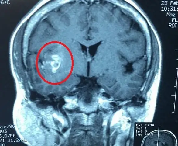 Phác Đồ Điều Trị Sán Chó