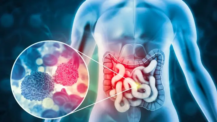 17ngăn Ngừa Ung Thư Đại Trực Tràng