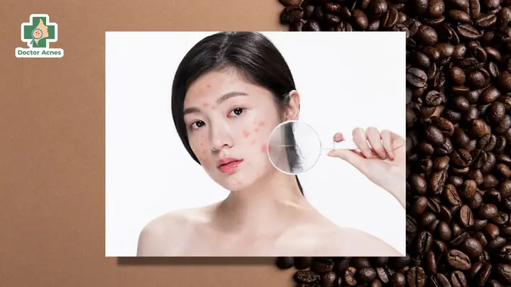 Uống Cafe Có Nổi Mụn Không