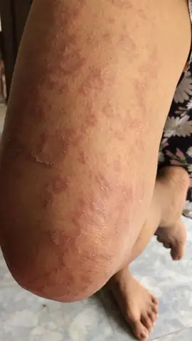 Sán Chó Ký Sinh Ở Đâu Trong Cơ Thể Người?