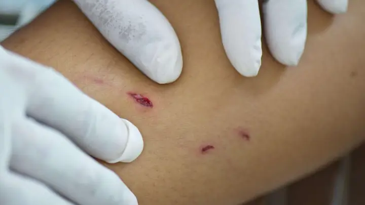 Sau Khi Bị Chó Cắn Bao Lâu Thì Chích Ngừa? Sau Khi Bị Chó Cắn Bao Lâu Thì Chích Ngừa?