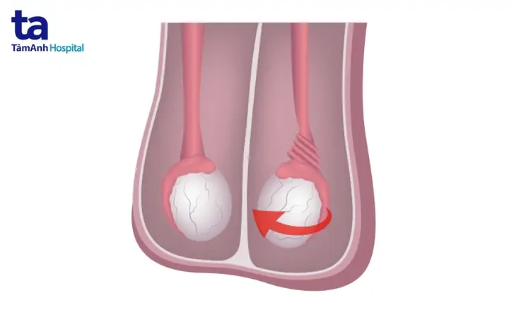 Tinh Hoàn Lạc Chỗ Có Nguy Hiểm Không?