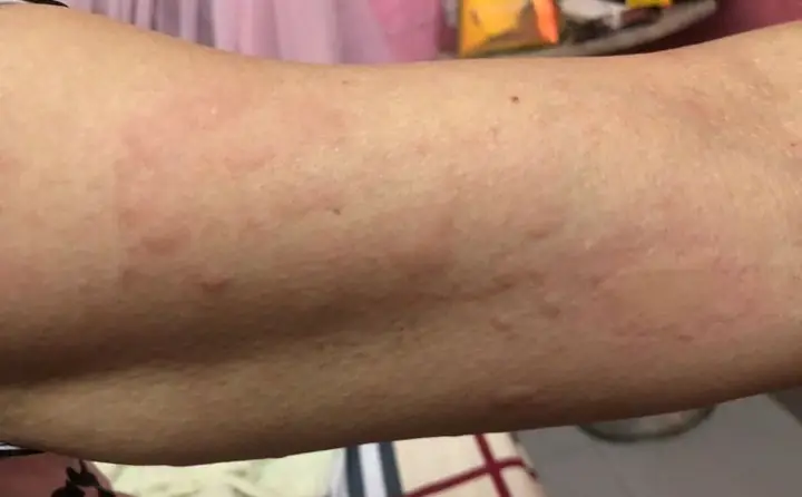 Biến Chứng Nguy Hiểm Do Giun Đũa Gây Ra