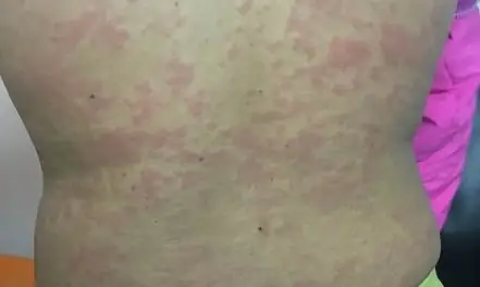 Xét Nghiệm Giun Đũa Chó Không Phải Cứ Dương Tính Là Bị Bệnh