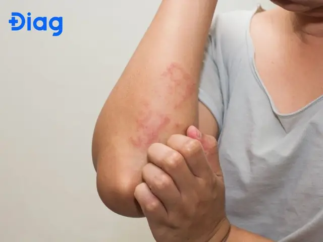 Ấu Trùng Di Chuyển Lên Não (neurotoxocariasis)